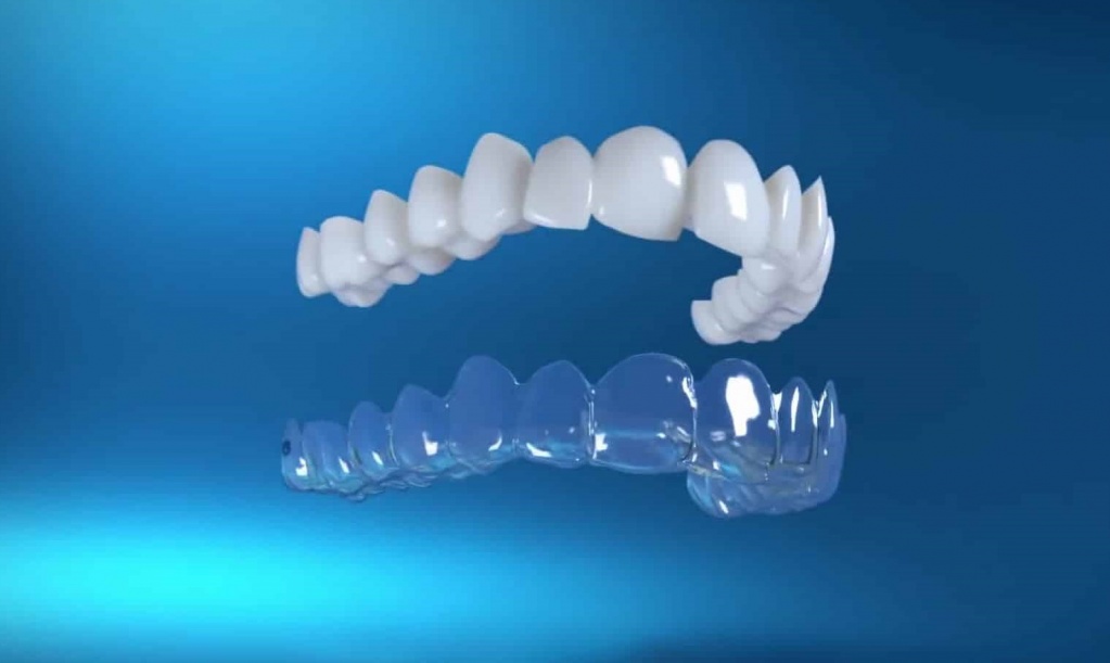 Invisible aligners for teeth straightening