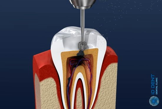 Депульпація зуба