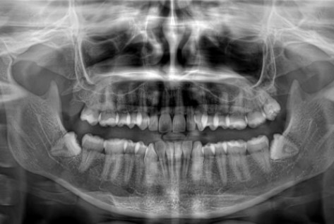 Рентгенодіагностика зубів