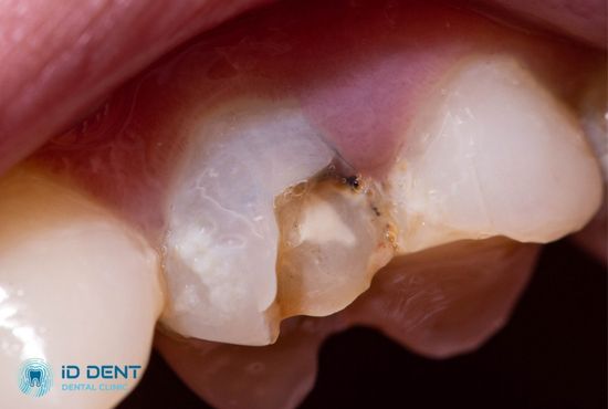 Кариес на зубах как показание к их реставрации