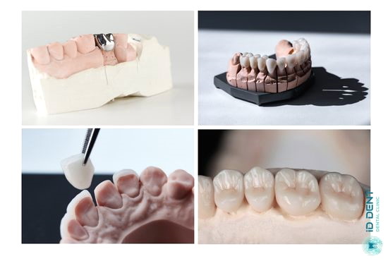 Види матеріалів для виготовлення незнімних зубних коронок