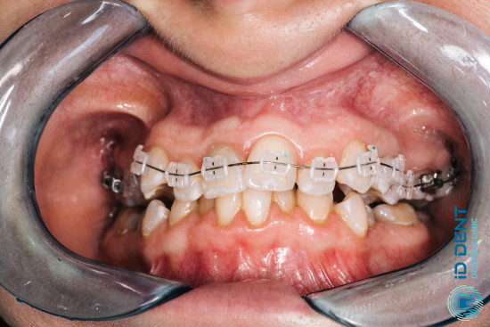 исправление скученности зубов с помощью керамических брекетов