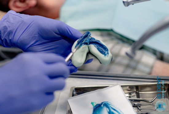 Зняття відбитків щелепи для виготовлення знімного зубного протеза