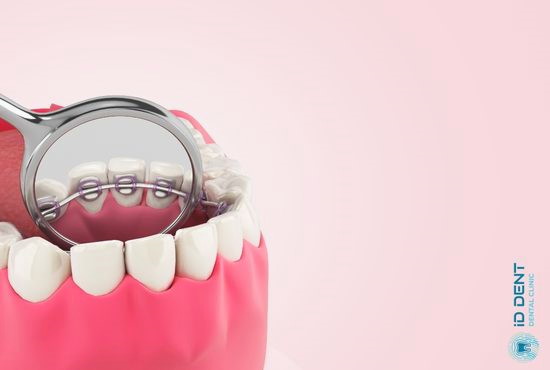 Внутренняя незаметная брекет-система на зубы