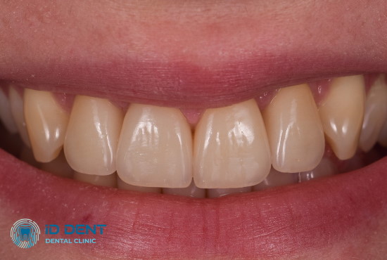 Усмішка після нарощування фронтальних зубів