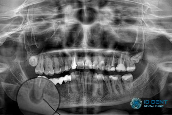 Рентгенодиагностика гранулемы зуба
