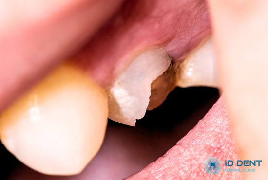 Скол зуба как показание к процедуре наращивания зуба