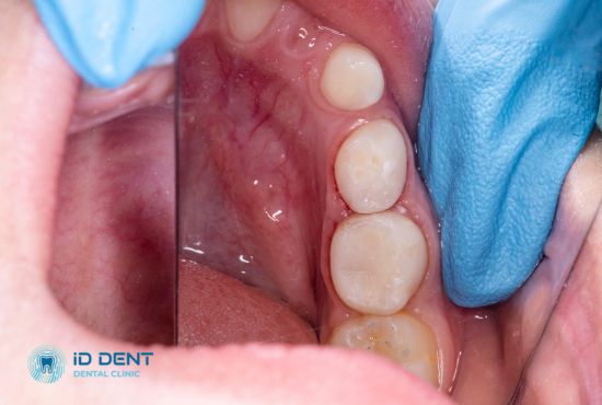 Фото по завершению пломбировки постоянного зуба у ребенка