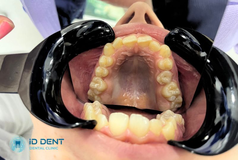 Искривленный зубной ряд как одно из показаний к брекетам